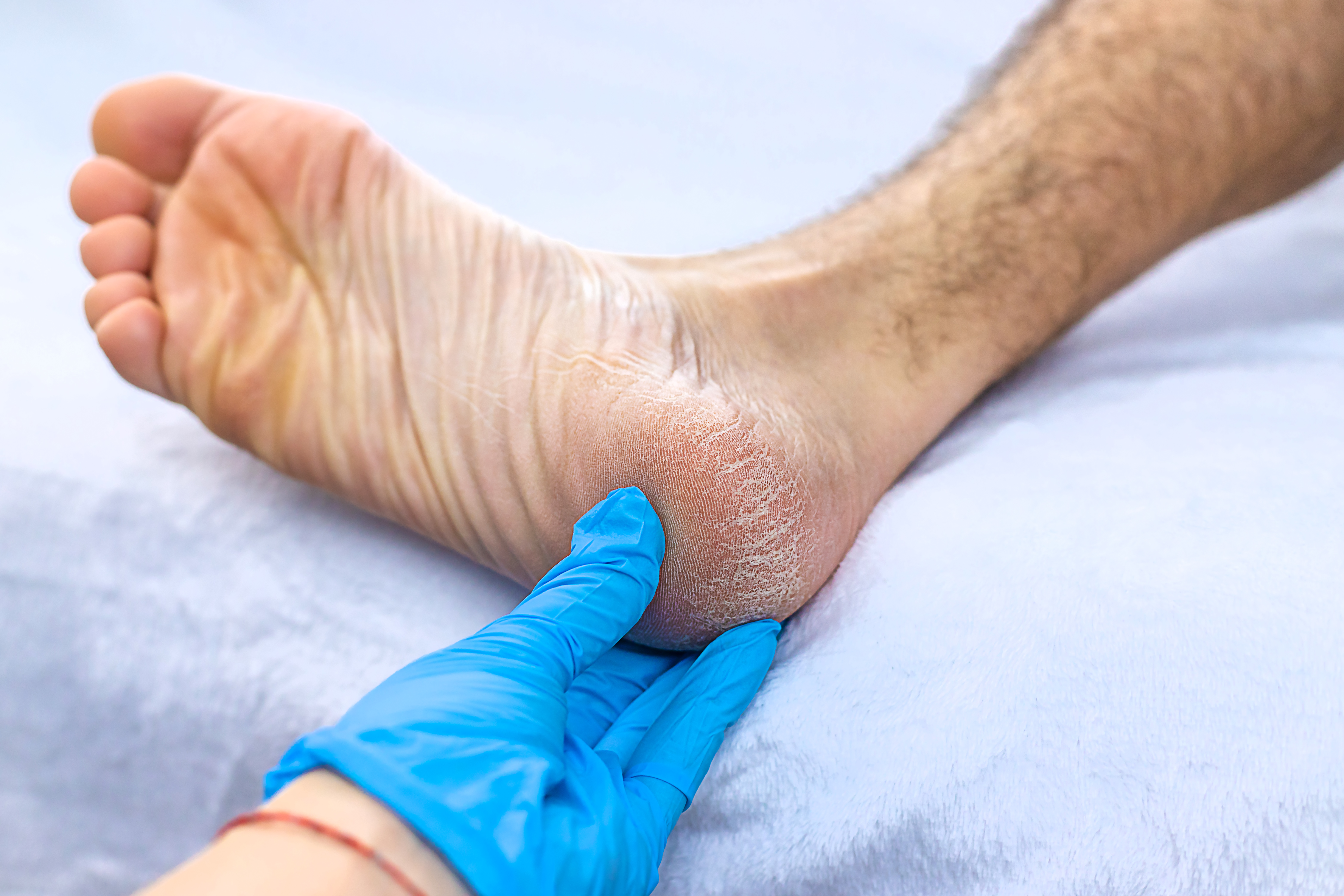 Fractures, Breaks, and Plantar Fasciitis | Heel That Pain